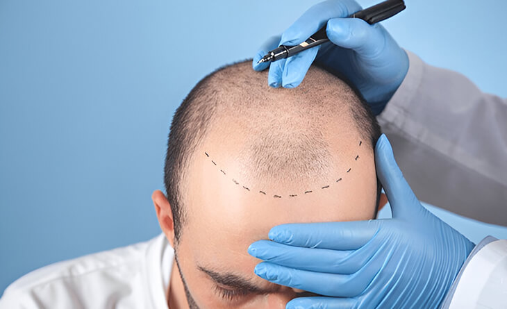 Hair Transplant Surgery