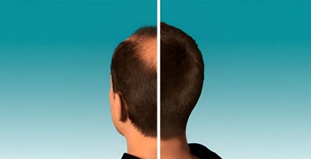 Hair Transplant Surgery