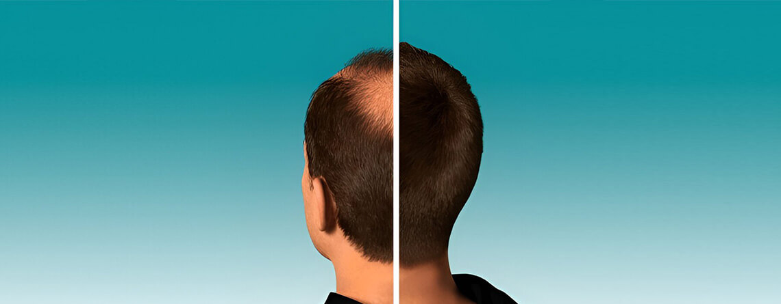 Hair Transplant Surgery