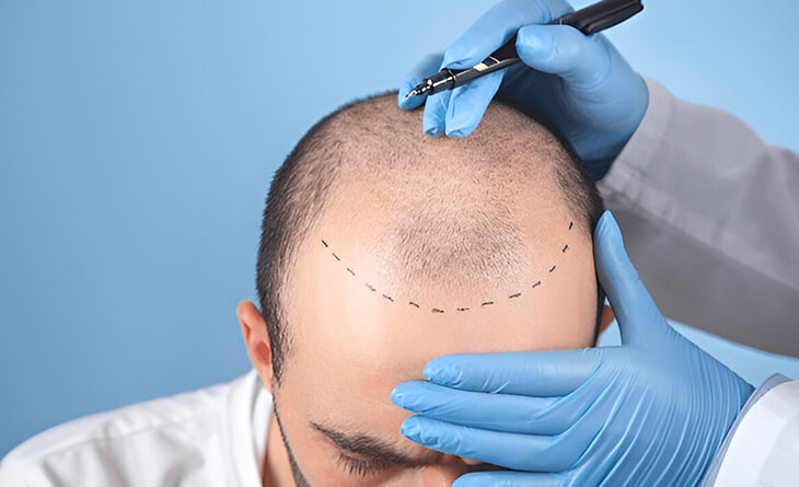 Hair Transplant Surgery