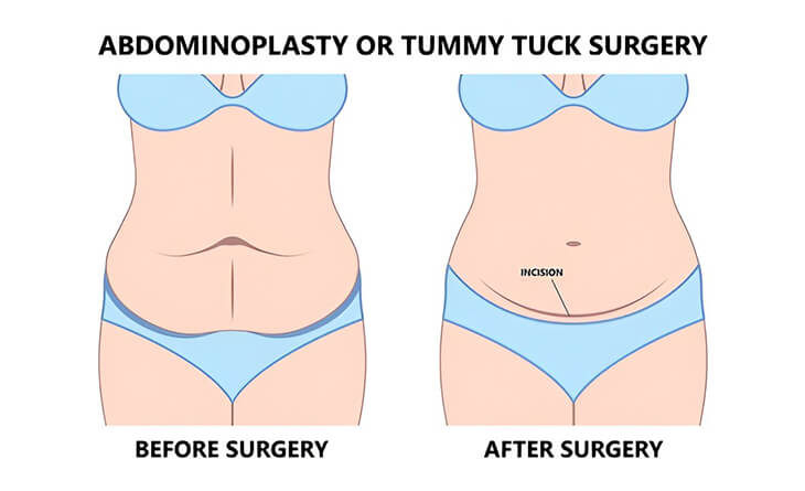 tummy tuck surgery