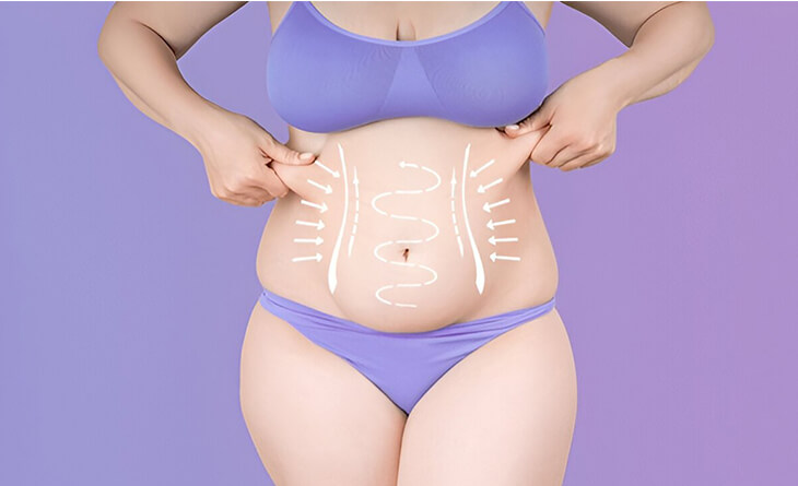 tummy tuck surgery