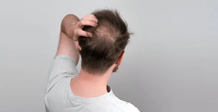 hair transplant