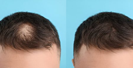 hair transplant