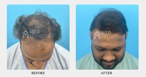 Hair Transplant - Dr Lokesh Handa - Med Esthetiks Delhi - 02