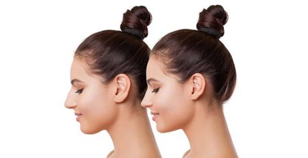 Rhinoplasty Surgery