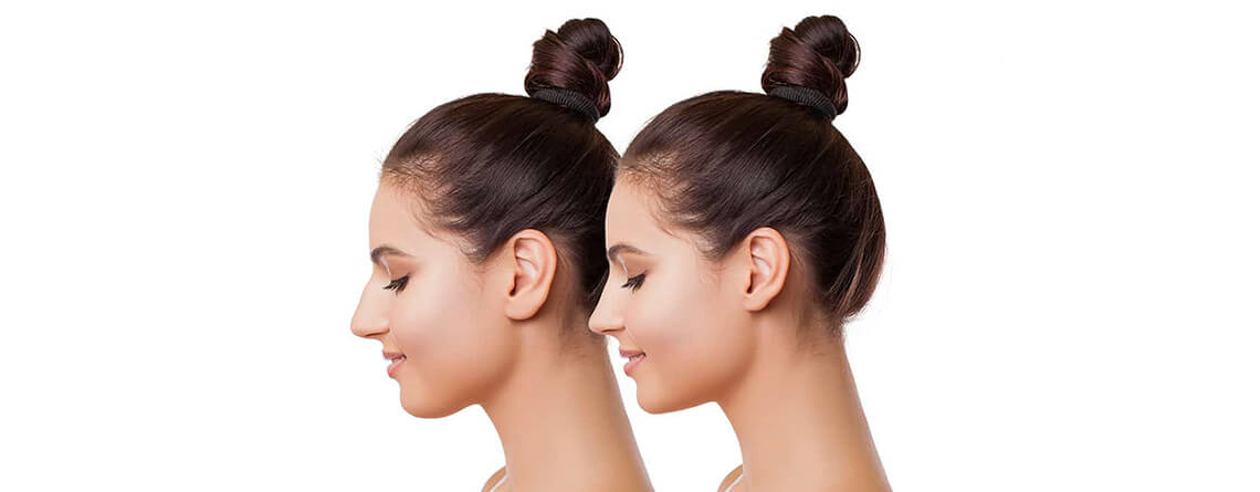 Rhinoplasty Surgery