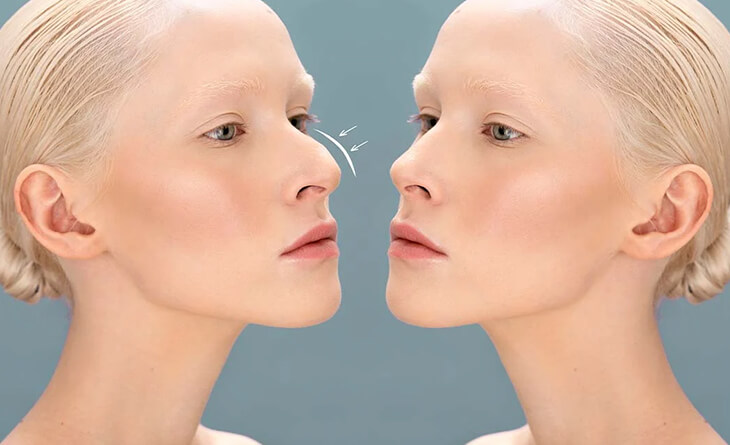 Rhinoplasty Surgery