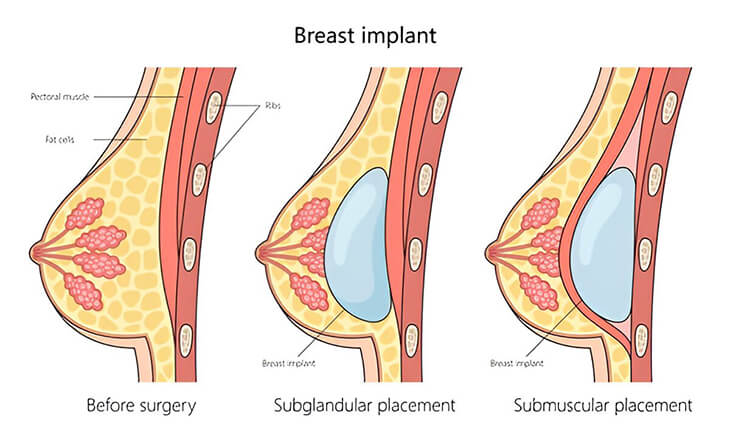 breast augmentation surgery