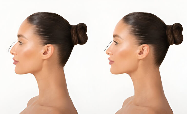 rhinoplasty surgery before and after