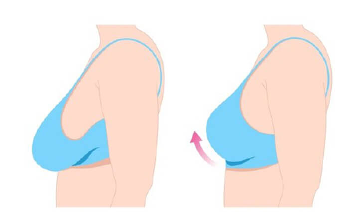 7 Best Cosmetic Surgery Procedures After Having Kids - Dr Lokesh Handa - Plastic Surgeon in Delhi -01 breast lift surgery