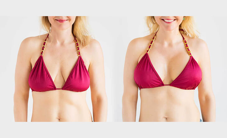 Breast Lift vs Breast Augmentation vs Breast Implants - Dr Lokesh Handa - Plastic Surgeon in Delhi -03 Breast Lift Surgery