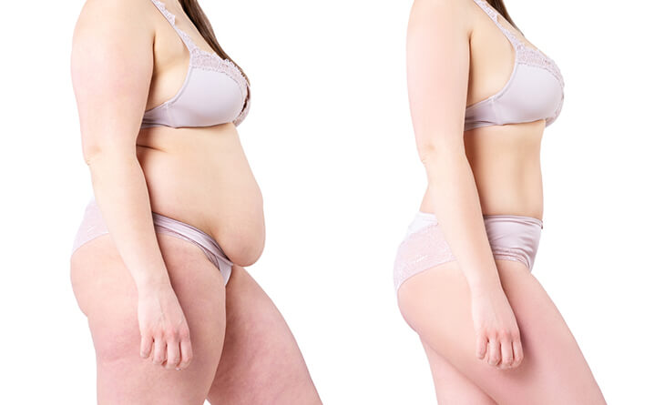 Top 5 Reasons Why Moms Are Opting for a Mommy Makeover - Dr Lokesh Handa - Plastic Surgeon in Delhi -03 liposuction surgery