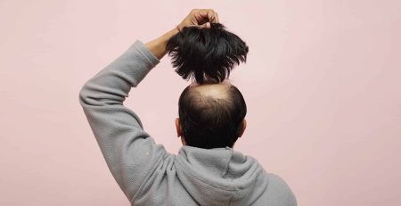 Hair Transplant Treatment