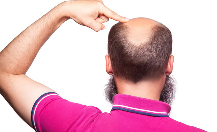 Which is the Better Treatment - Hair Transplant or Hair Wig - Dr Lokesh Handa - Plastic Surgeon in Delhi -02 Hair Transplant Treatment