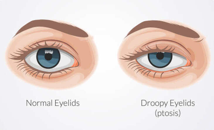 Blepharoplasty surgery procedure - Dr Lokesh Handa - Plastic Surgeon in Delhi -01 eyelid surgery