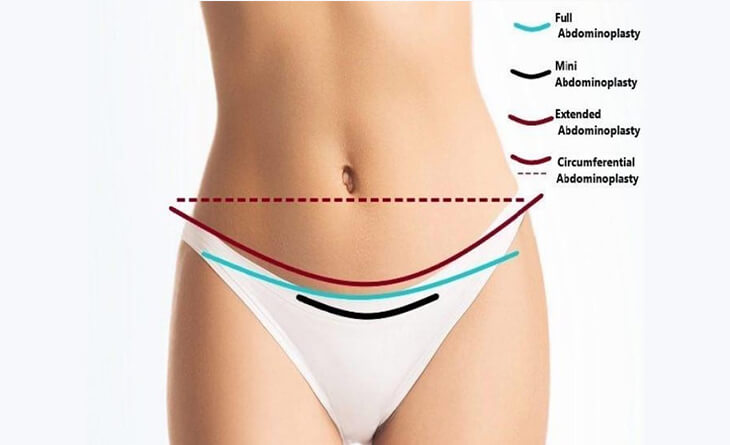Is a Drainless Tummy Tuck Surgery Right for You - Dr Lokesh Handa - Plastic Surgeon in Delhi - Med Esthetiks -01 tummy tuck surgery