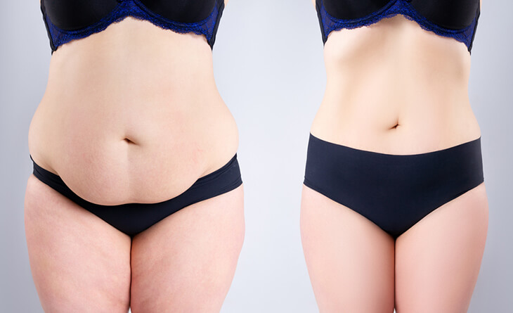 Is a Drainless Tummy Tuck Surgery Right for You - Dr Lokesh Handa - Plastic Surgeon in Delhi - Med Esthetiks -03 tummy tuck surgery