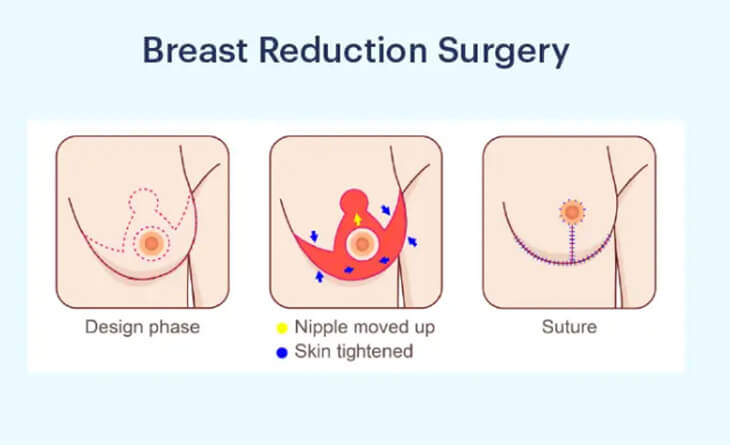 Is Breast Reduction Surgery Safe During Pregnancy - Dr Lokesh Handa - Plastic Surgeon in Delhi - Med Esthetiks -03 breast reduction surgery