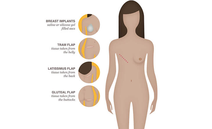 What Kind of Breast Surgery Should You Get - Dr Lokesh Handa - Plastic Surgeon in delhi -03 breast augmentation procedure