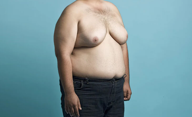 Can Gynecomastia Be Treated Without Surgery - gynecomastia surgery in delhi - Dr Lokesh Handa - Med Esthetiks -02 gynecomastia surgery