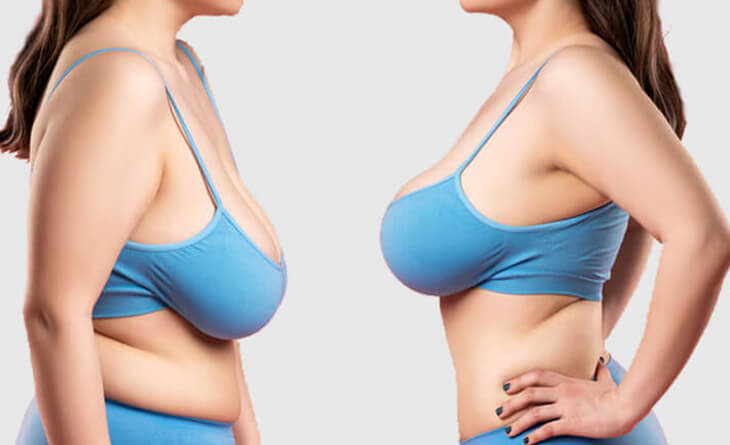 How To Know If A Breast Reduction Surgery Is Right For You - Dr Lokesh Handa - Plastic Surgeon in Delhi - Med Esthetiks -03 breast reduction surgery