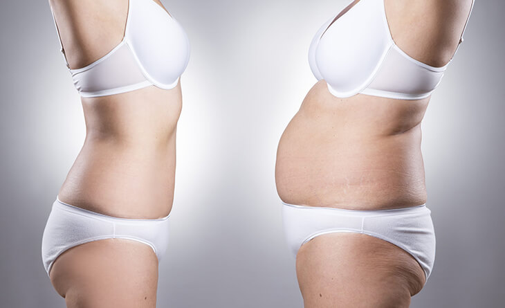 Ideal Conditions for a Tummy Tuck Surgery - Dr Lokesh Handa - Plastic Surgeon in Delhi -03 tummy tuck surgery