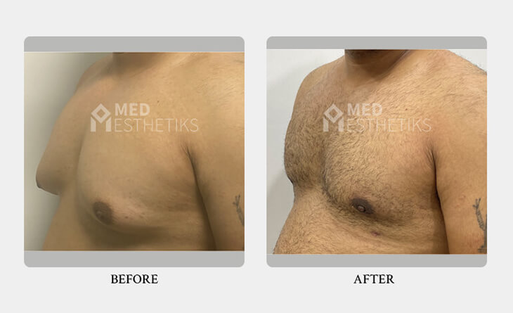 Where Can I Get a Male Breast Reduction Surgery - Dr Lokesh Handa - Plastic surgeon in Delhi - -03 gynecomastia surgery before and after