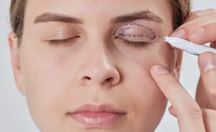 Will Eyelid Surgery Change Your Eye Shape - Dr Lokesh Handa - Plastic Surgeon in Delhi -01 eyelid surgery