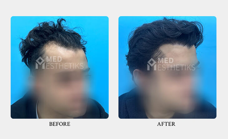 Is Hair Transplant Safe and Permanent - Dr Lokesh Handa - Hair Transplant Surgeon in Delhi - Med Esthetiks -02 hair transplant surgery before and after