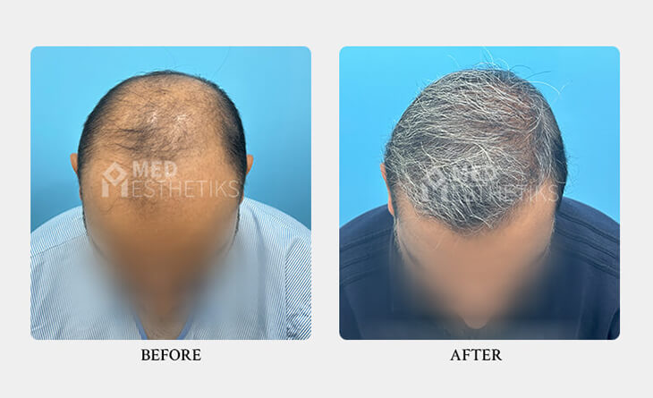 Is Hair Transplant Safe and Permanent - Dr Lokesh Handa - Hair Transplant Surgeon in Delhi - Med Esthetiks -03 hair transplant surgery before and after