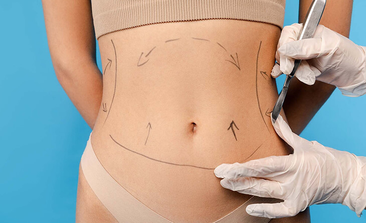 Is Liposuction surgery 100% Safe - Dr Lokesh Handa - Plastic Surgeon in Delhi - Med Esthetiks -03 liposuction surgery