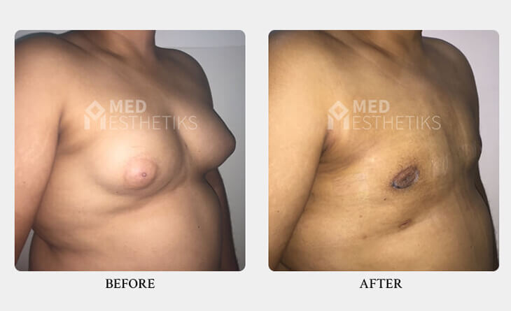 The Benefits of Male Breast Reduction at Med Esthetiks - Dr Lokesh Handa - Best Gynecomastia Surgeon in Delhi -01 gynecomastia surgery