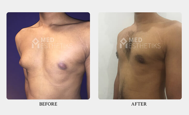The Benefits of Male Breast Reduction at Med Esthetiks - Dr Lokesh Handa - Best Gynecomastia Surgeon in Delhi -03 gynecomastia surgery before and after