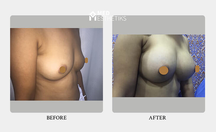Choosing the Right Surgeon for Breast Augmentation Surgery - Dr Lokesh Handa - Med Esthetics -02 breast augmentation surgery