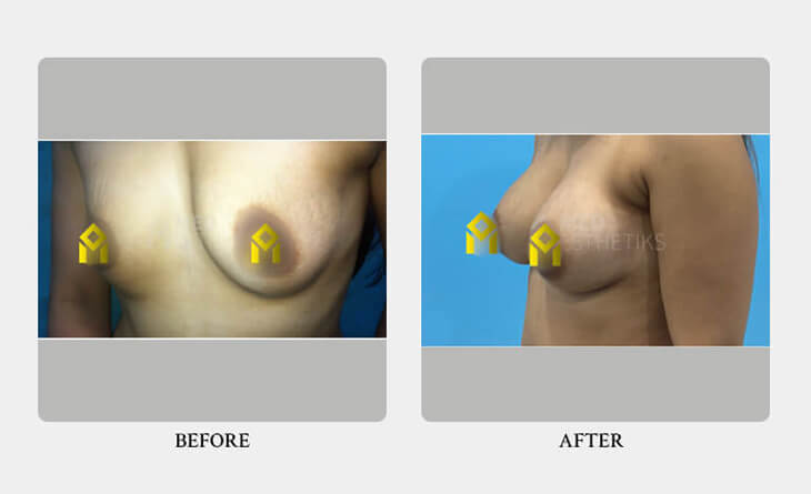 Choosing the Right Surgeon for Breast Augmentation Surgery - Dr Lokesh Handa - Med Esthetics -03 breast augmentation surgery before and after