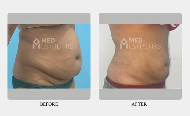 Is Liposuction Surgery Safe - Dr Lokesh Handa - Plastic Surgeon in Delhi - Med Esthetiks -03 liposuction surgery before and after
