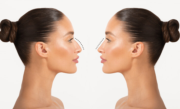 How Long After Rhinoplasty Can I Wear Glasses - Rhinoplasty surgery - Dr Lokesh Handa - Med Esthetiks -02 nose reshaping surgery