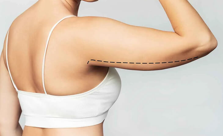 Tips and Tricks for a Successful Arm Liposuction Recovery - Dr Lokesh Handa - Plastic Surgeon in Delhi -01 Arm liposuction surgery