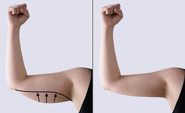 Tips and Tricks for a Successful Arm Liposuction Recovery - Dr Lokesh Handa - Plastic Surgeon in Delhi -02 Arm liposuction surgery