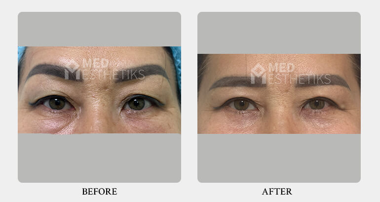 Blepharoplasty before after - Dr Lokesh Handa -Med Esthetiks -02 Blepharoplasty before after - Dr Lokesh Handa -Med Esthetiks -02