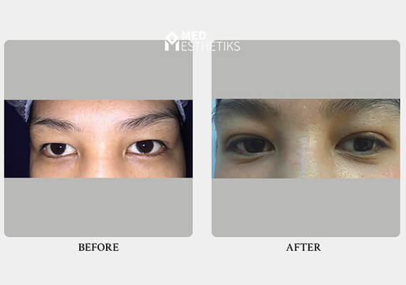 Recovery and Results - Med Esthetiks Recovery and Results - Med Esthetiks