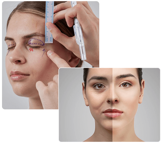 What Is Blepharoplasty - Med Esthetiks What Is Blepharoplasty - Med Esthetiks