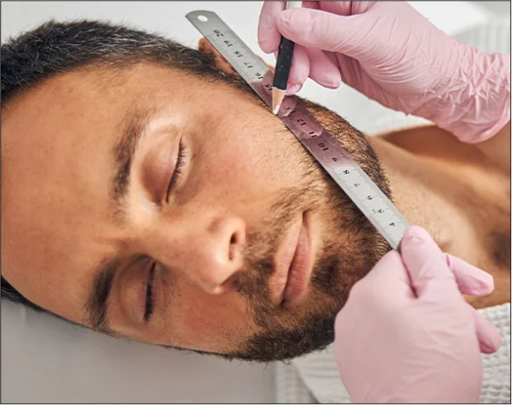 Med Esthetiks_Beard Transplant Cost in Delhi_17