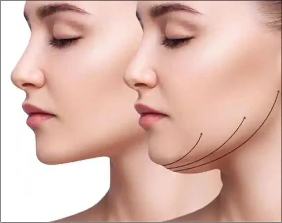 Med Esthetiks_Double Chin Procedure and Recovery_10